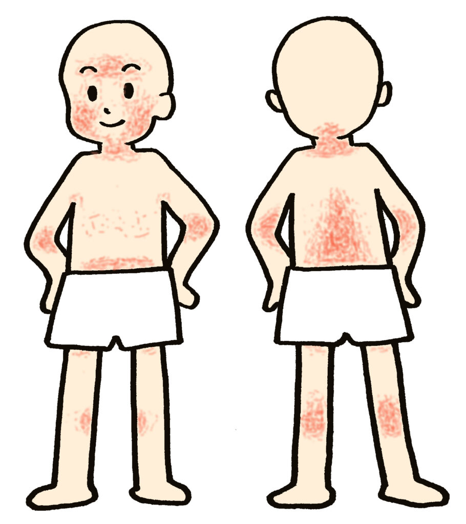 アトピー性皮膚炎　思春期・成人期の好発部位