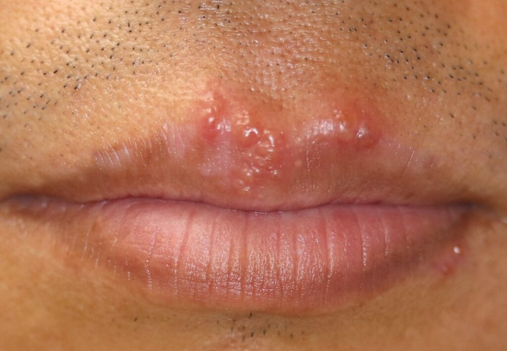 口唇ヘルペスの臨床写真