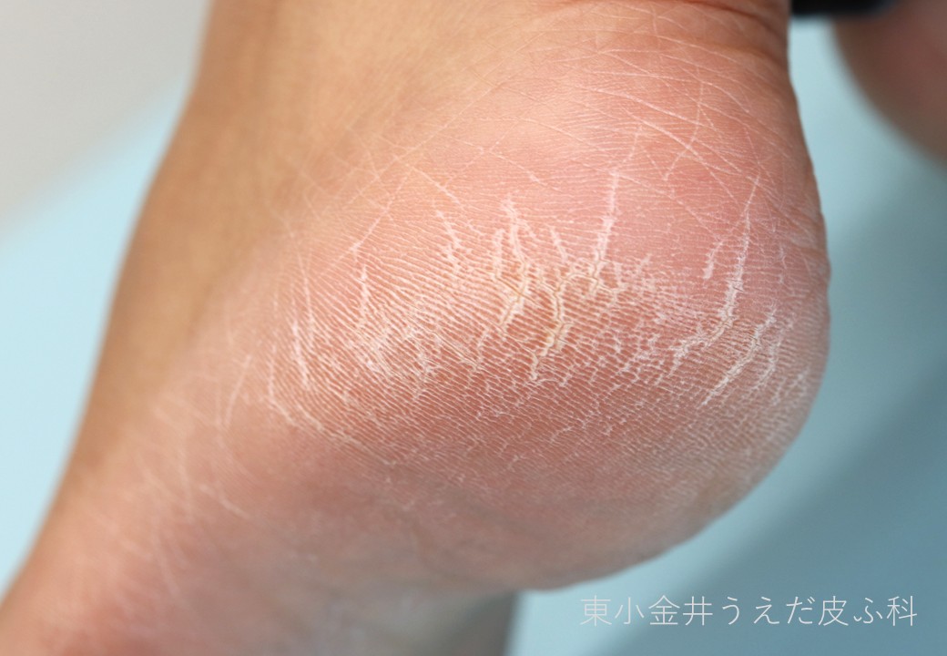 踵のがさがさ・ひび割れの臨床写真