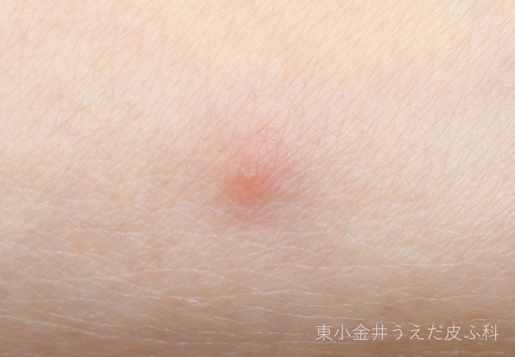 虫刺されの臨床写真