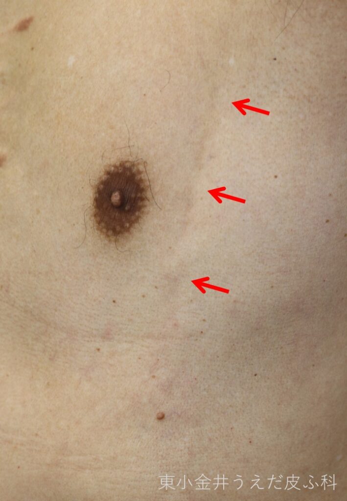 モンドール病の臨床写真