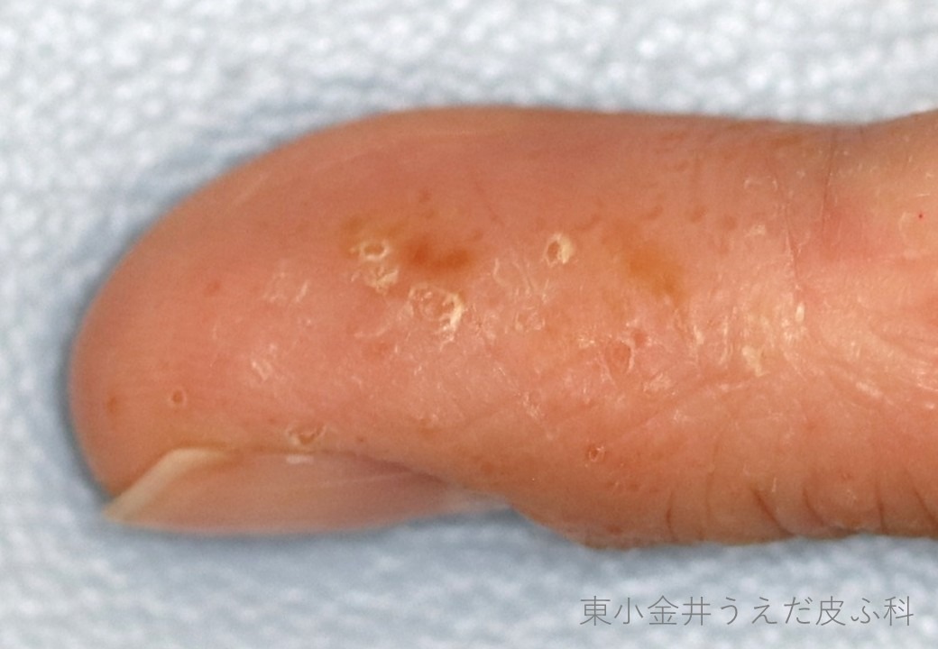 異汗性湿疹の臨床写真