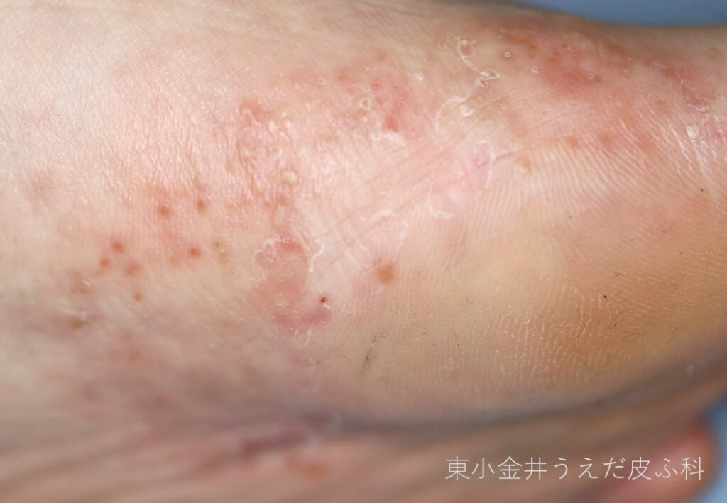 足白癬(水疱)の臨床写真