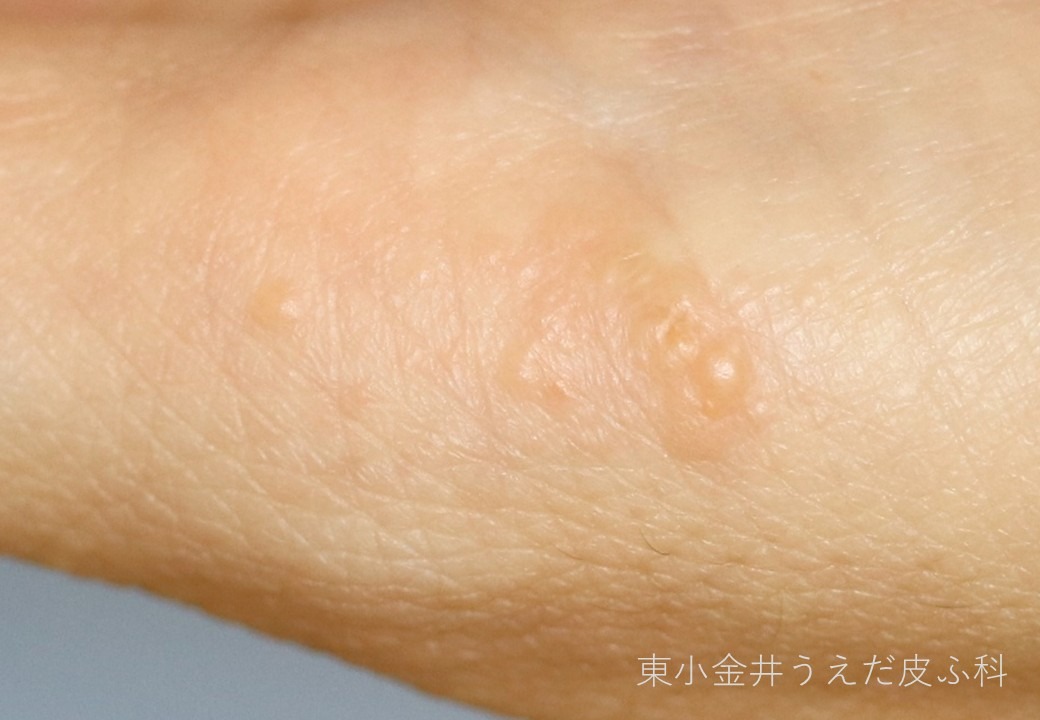 汗疱の臨床写真