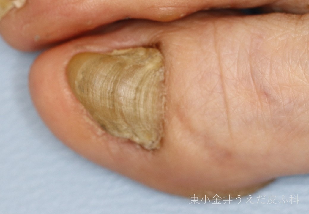 爪甲鉤彎症の臨床写真