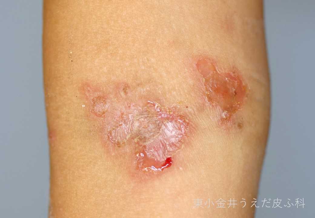 伝染性膿痂疹の臨床写真