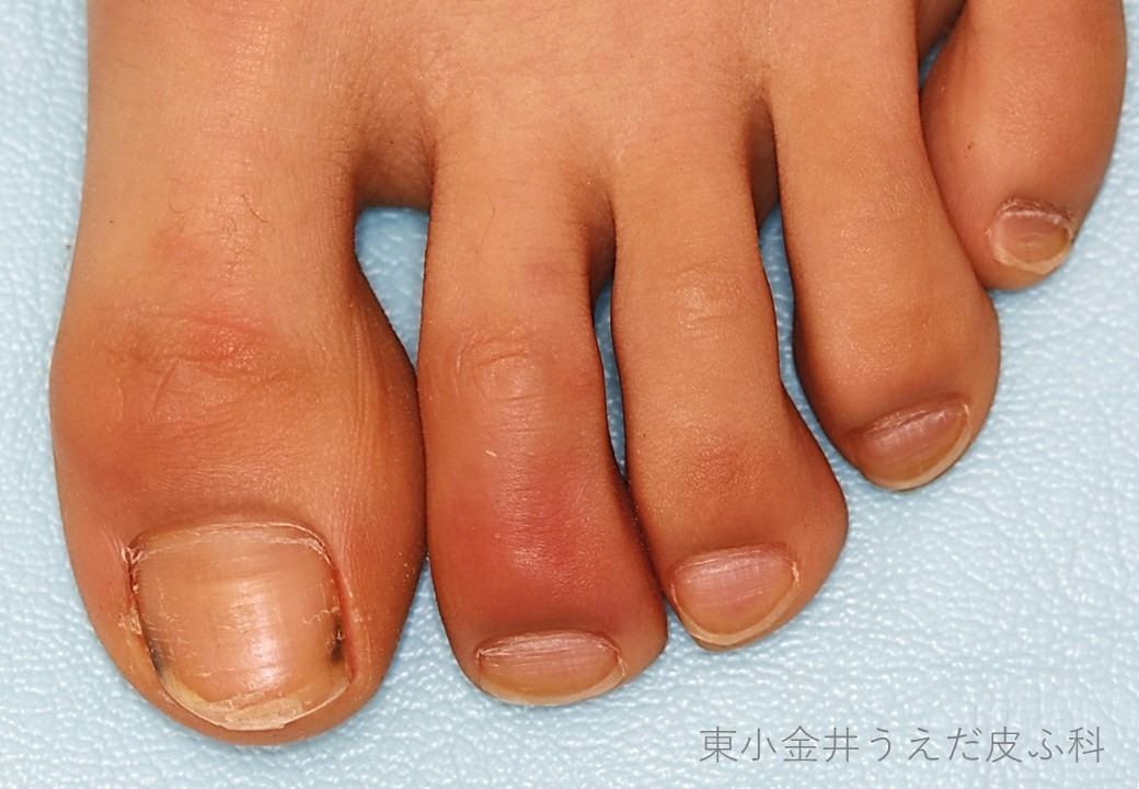 凍瘡の臨床写真