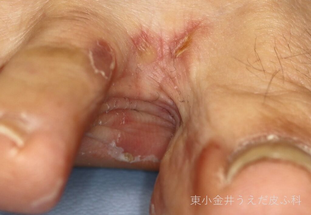 足白癬(趾間)の臨床写真