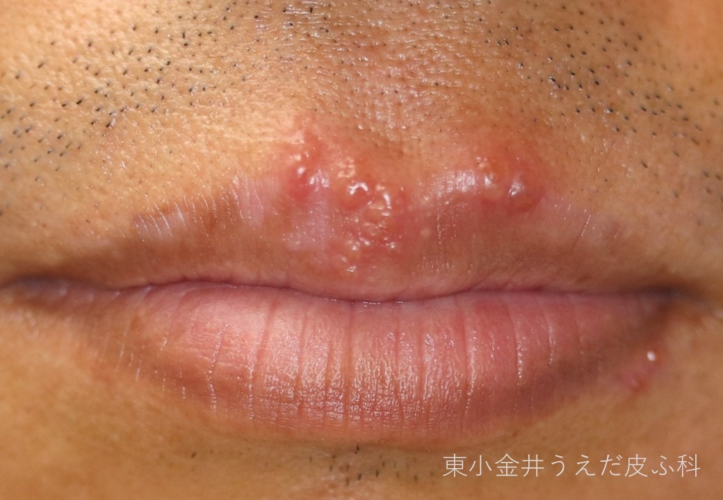 口唇ヘルペスの臨床写真