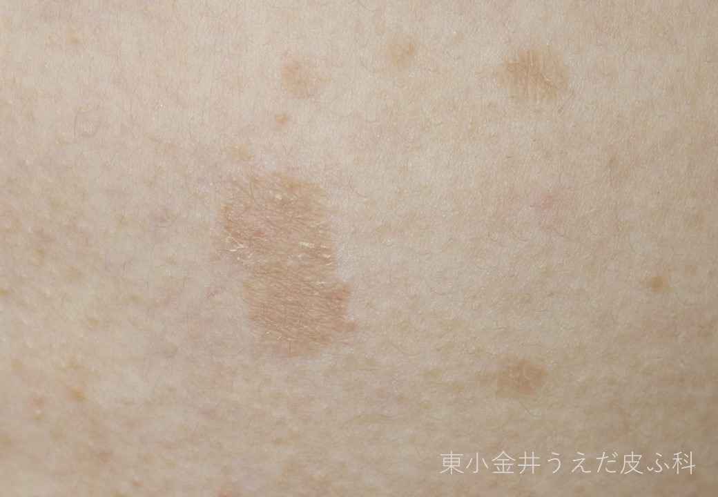 癜風の臨床写真