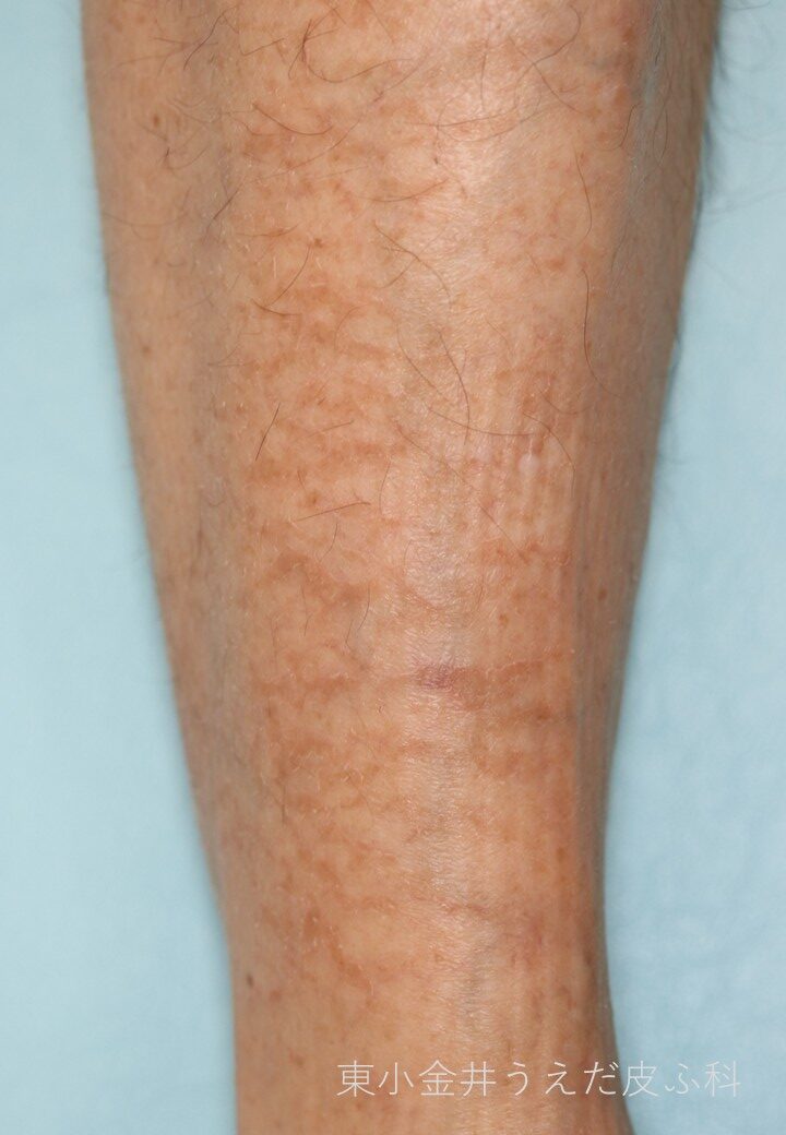 皮脂欠乏性皮膚炎の臨床写真