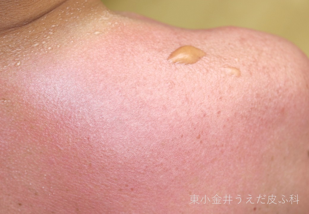 日焼けによる皮膚炎の臨床写真