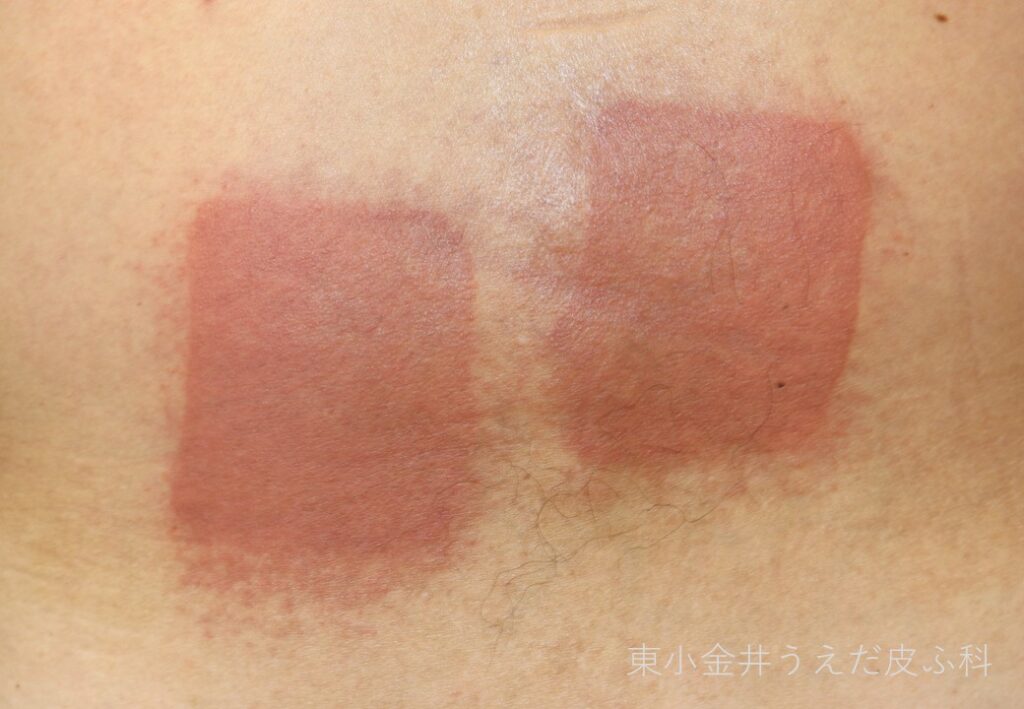 湿布による接触皮膚炎の臨床写真