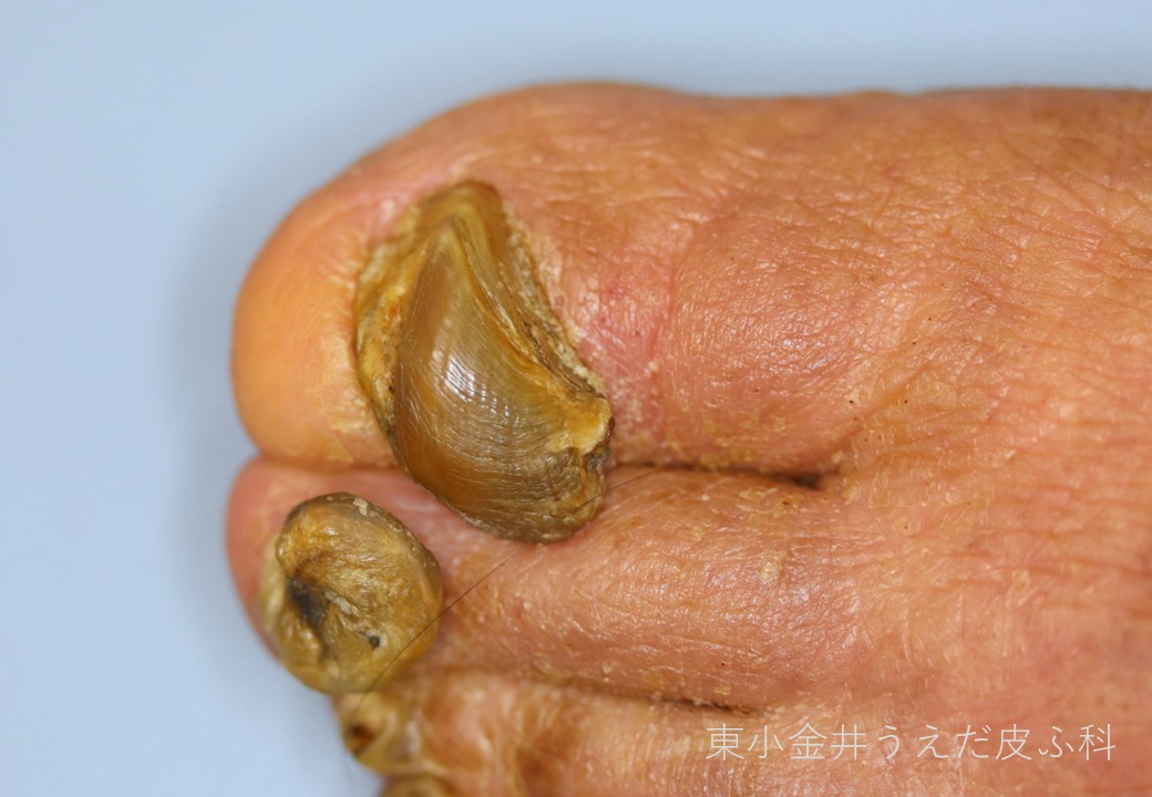 爪甲鉤彎症の臨床写真