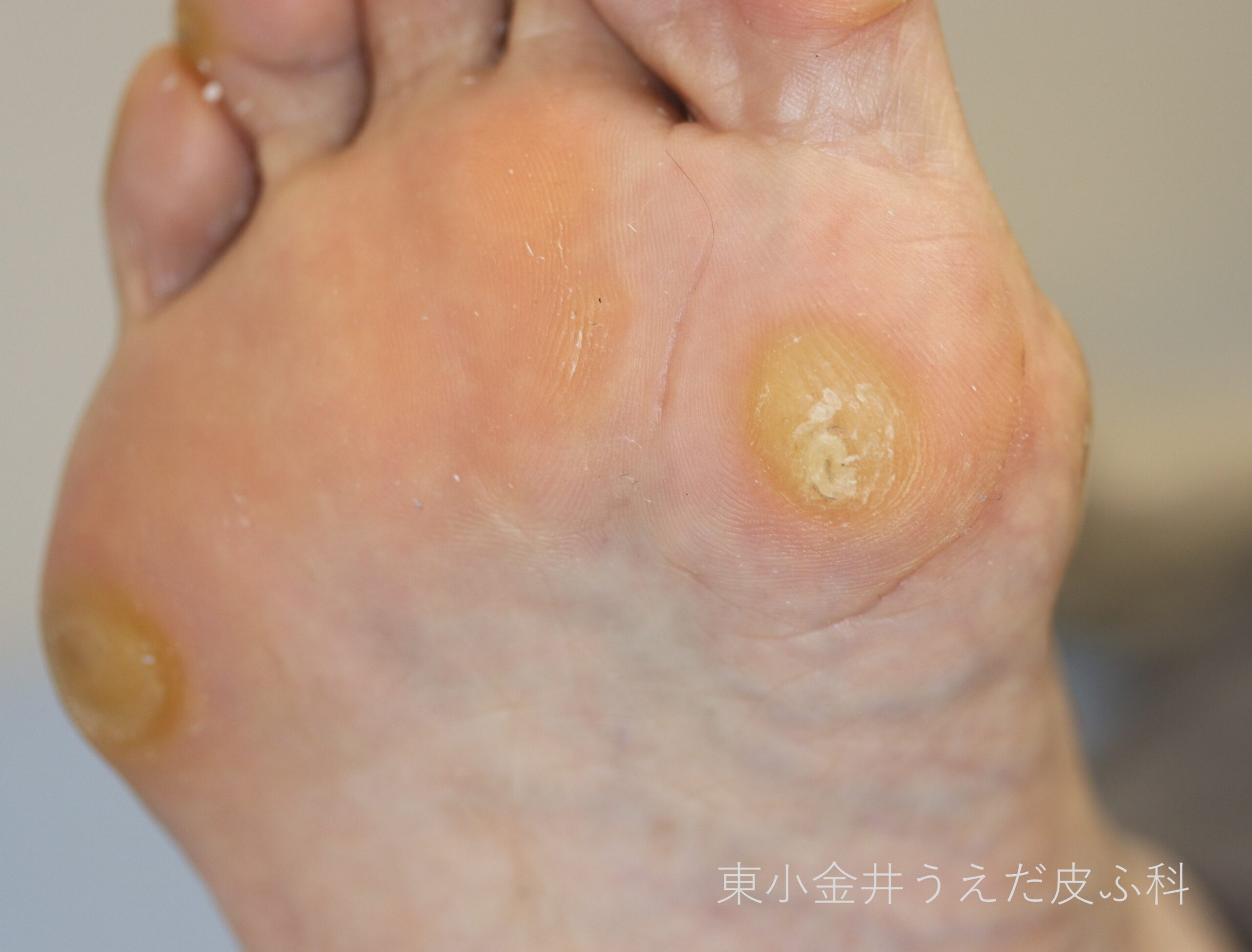 胼胝の臨床写真