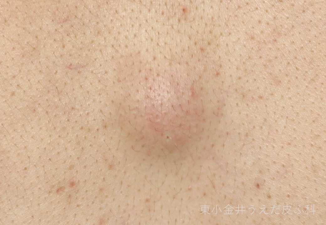 粉瘤の臨床写真