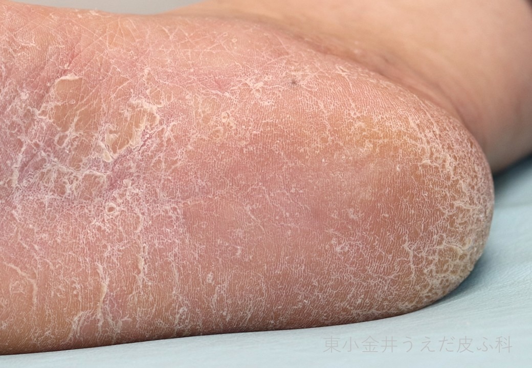 足白癬（角化型）の臨床写真