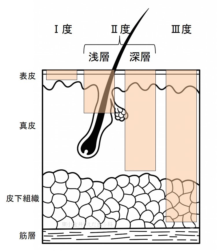熱傷_深さによる重症度
