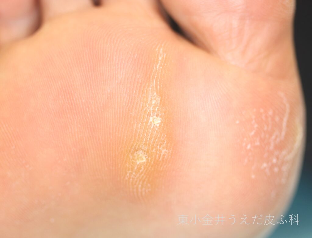 鶏眼