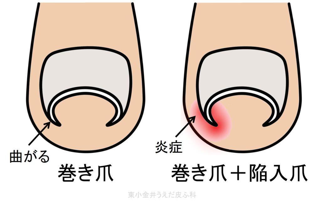 巻き爪と陥入爪を合併した巻き爪