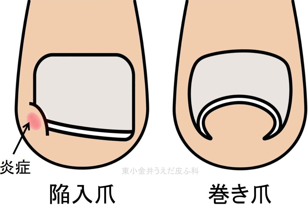陥入爪と巻き爪